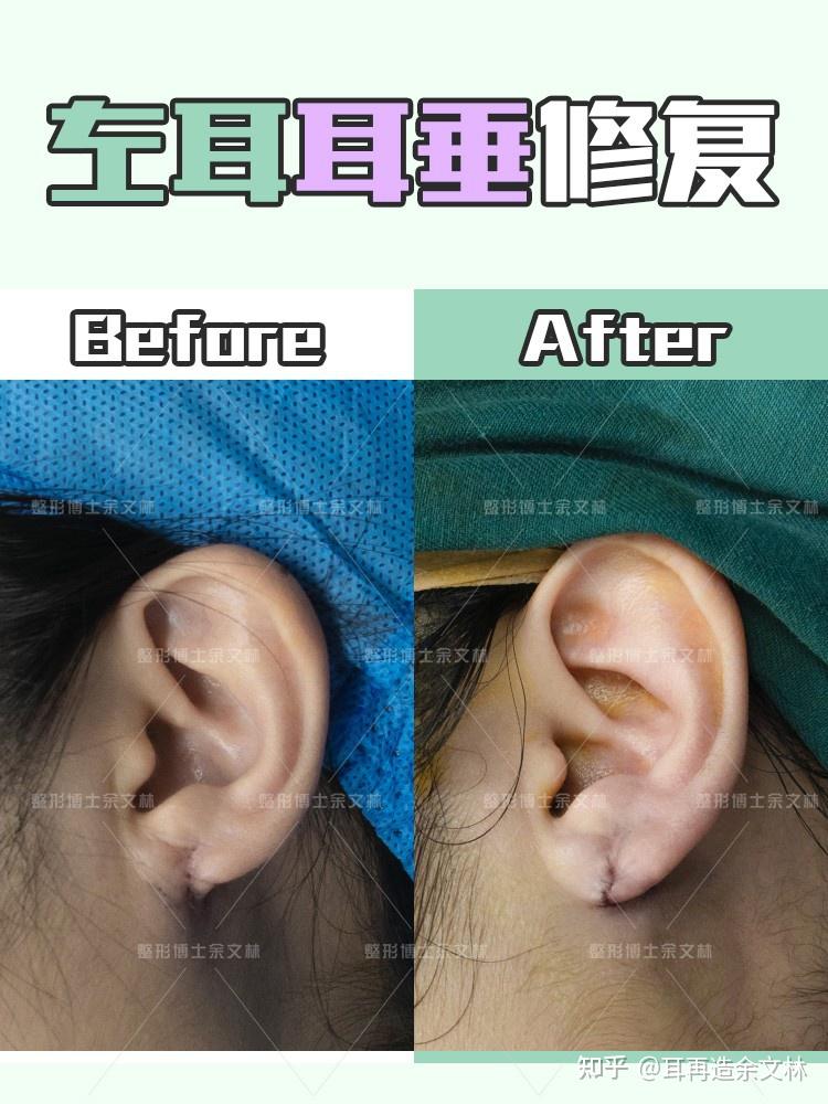 原来戴耳环真的会导致耳垂裂开王一博他们就是一个例子