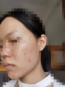 怎样才能让脸上没痘痘 v2-b0028350f20326279ccc408cc2eb5419_b.jpg