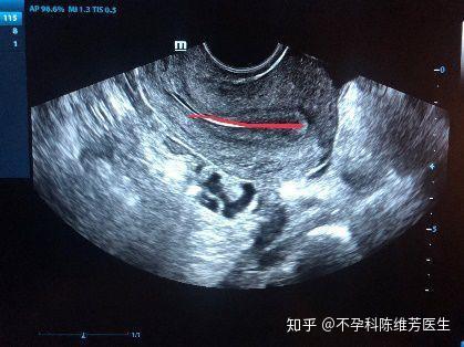 子宫前位、后位、水平位,到底啥意思?一次性帮你搞清楚! - 知乎