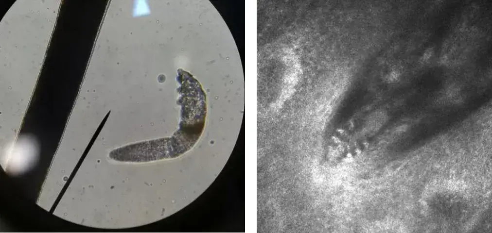 经过共聚焦显微镜检查,结果证实,张女士的睫毛根部存在大量的蠕形螨