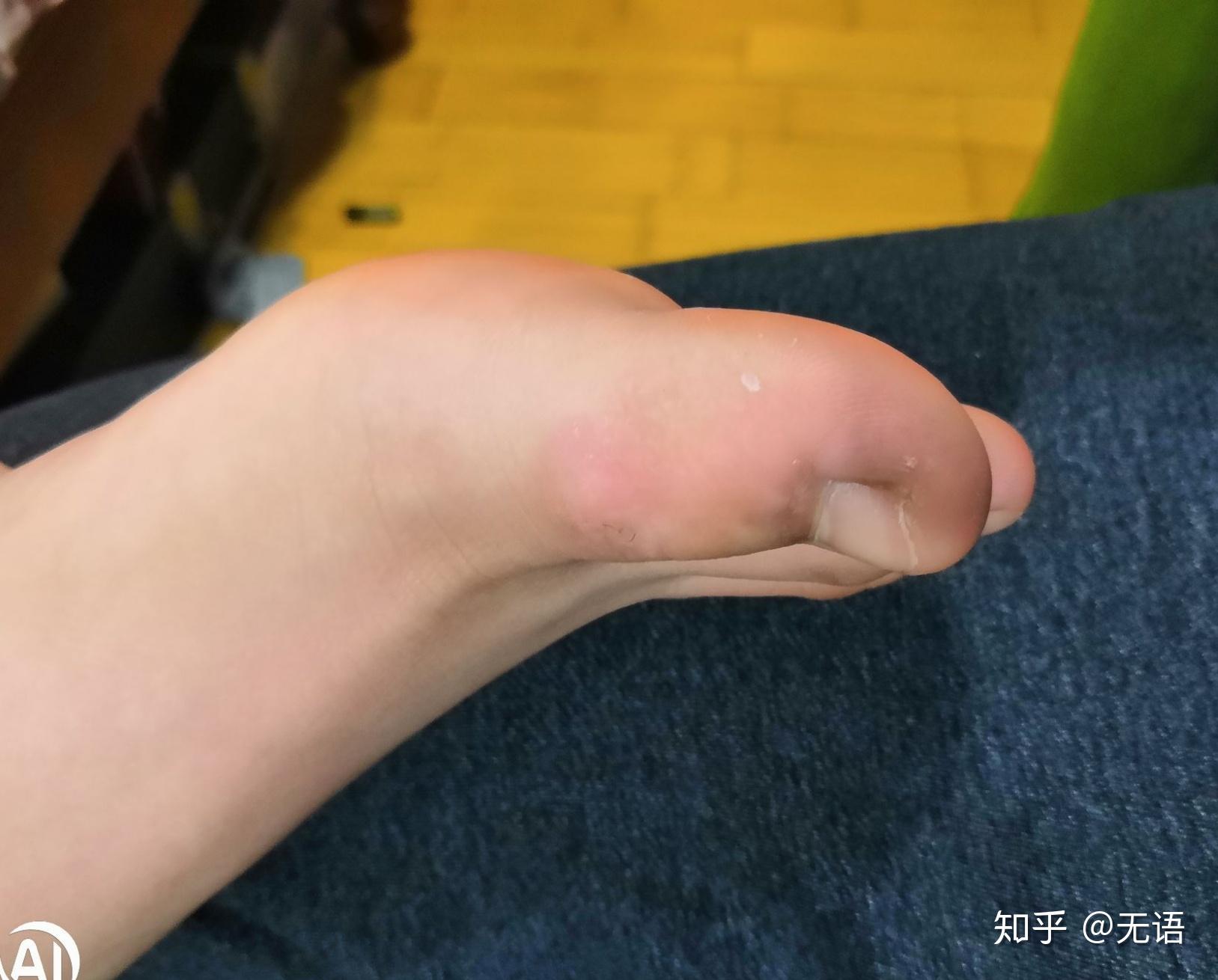 治疗瘊子寻常疣的偏方醋精个人体验