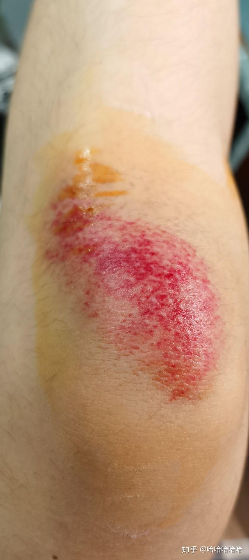 跑步摔倒,腿部,手臂擦伤,后续记录