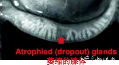 睑板腺功能障碍 - 知乎