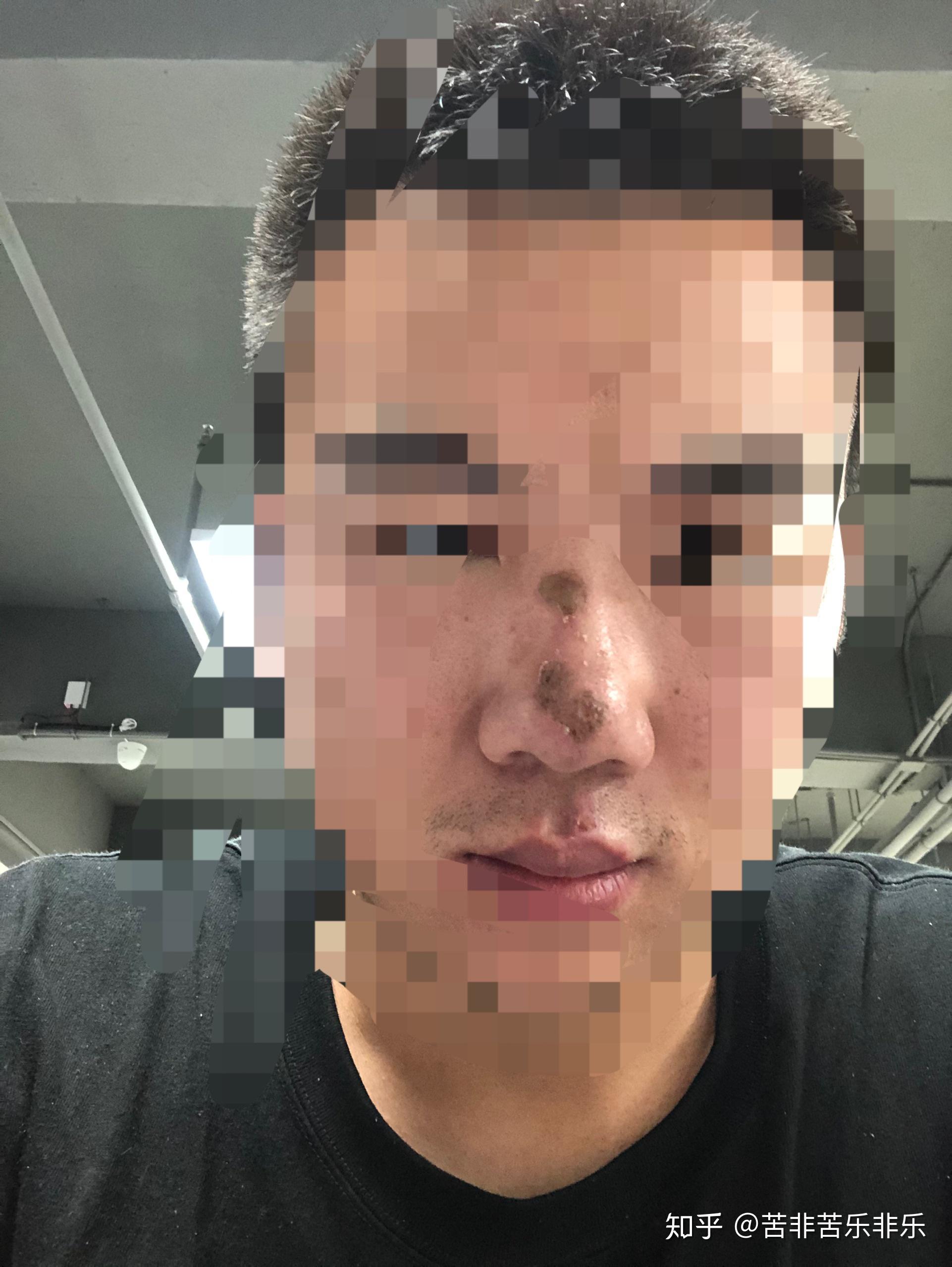 鼻子擦伤 - 知乎