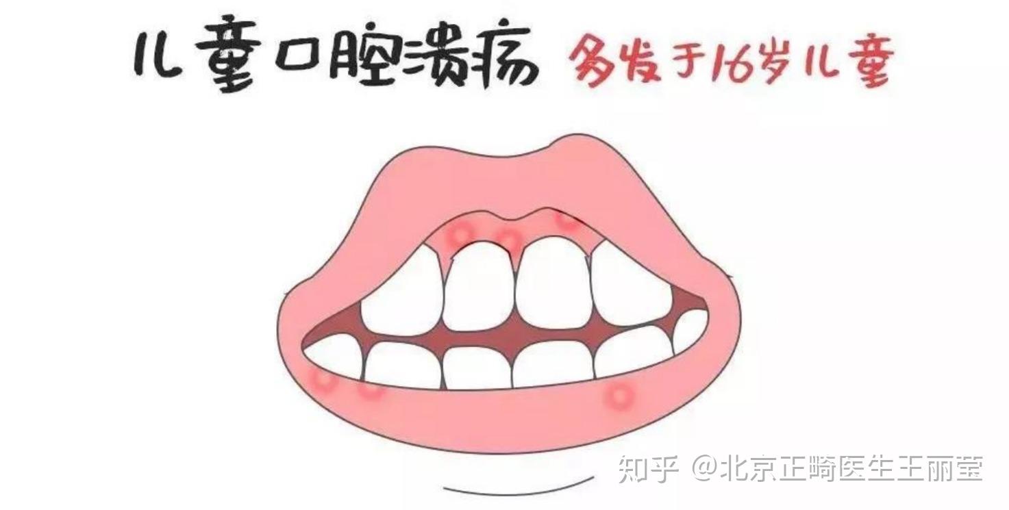 进入寒冬当心孩子的口腔溃疡