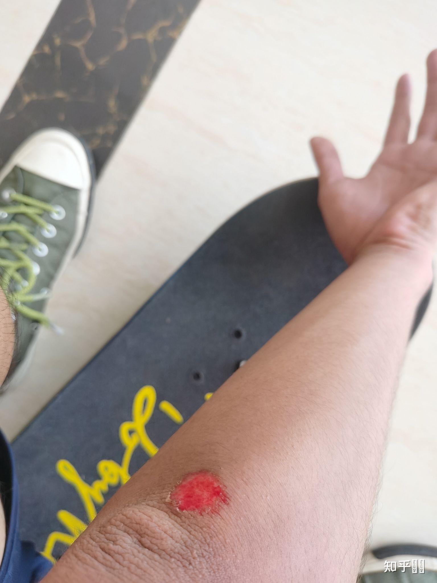 玩滑板摔倒是一种怎样的体验