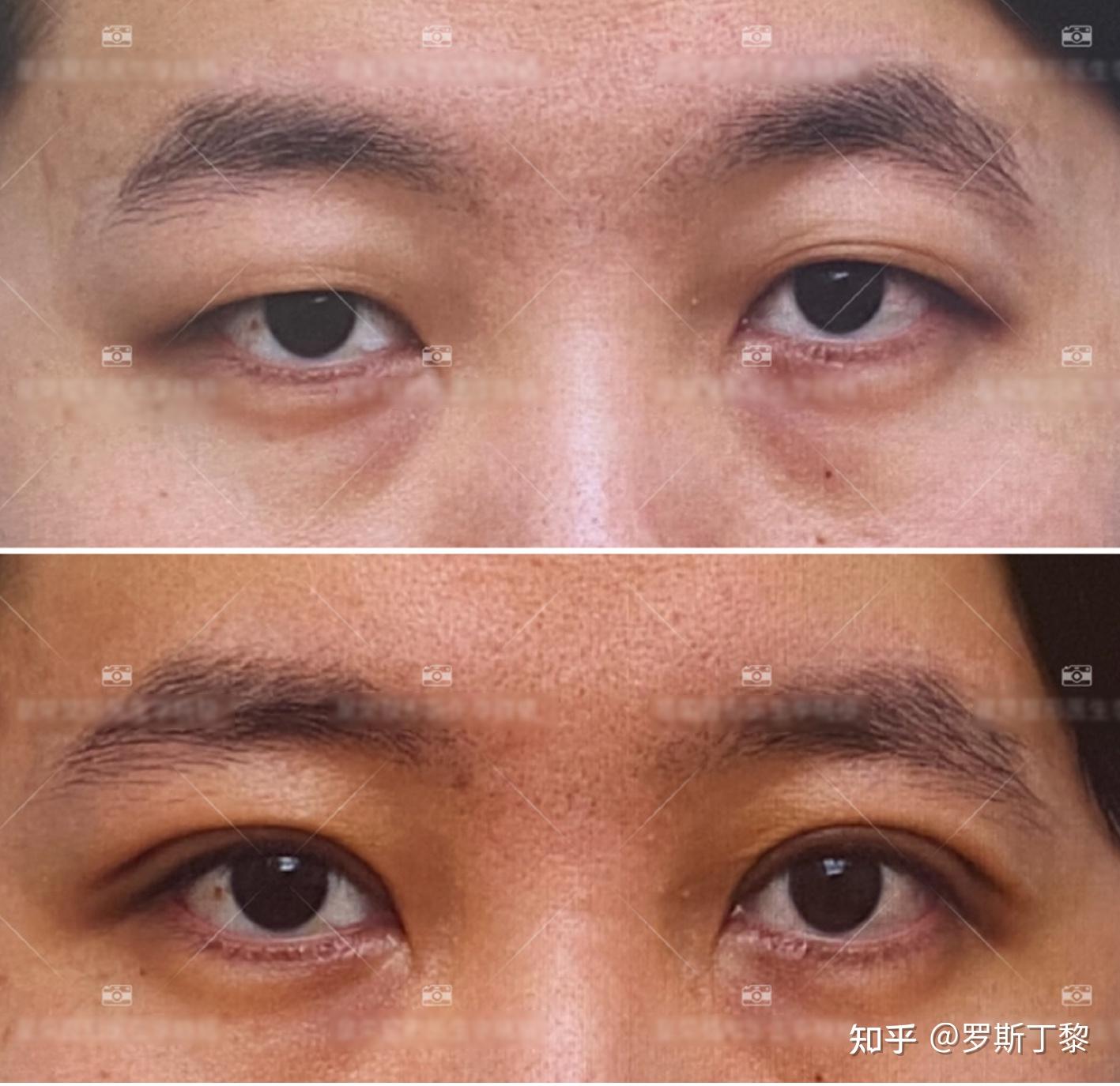 女生大多是眼角内眦赘皮,而男生大多会有提肌无力的现象,也就是上眼睑