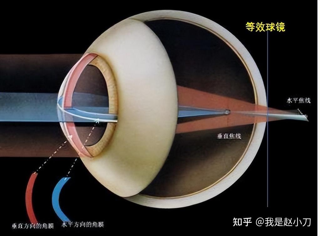 23mm,表示晶状体厚度3.