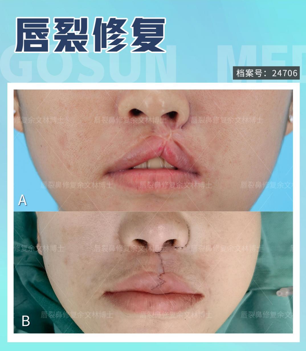 【案例分析】患者白唇疤痕挛缩,上唇跟着被提上去了