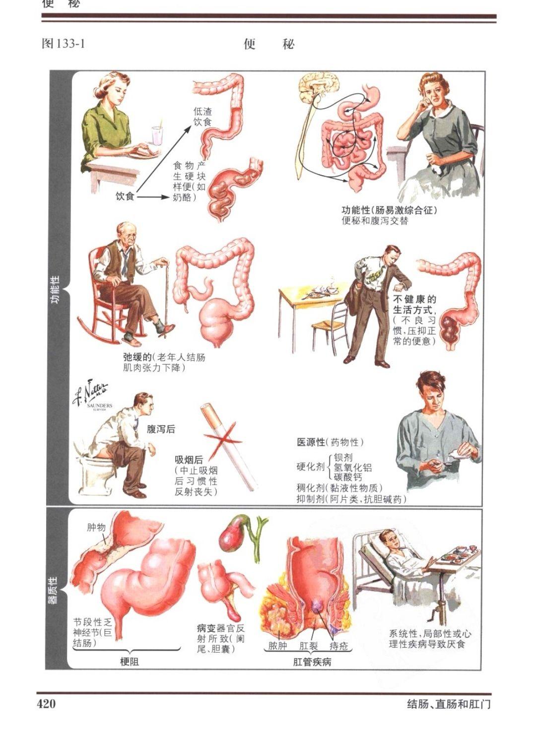 功能性胃肠病—功能性便秘 - 知乎