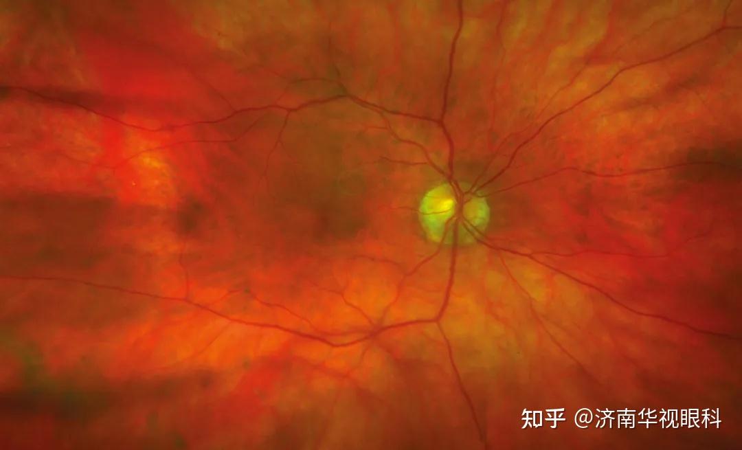 飞蚊症有治了激光玻璃体消融术了解一下