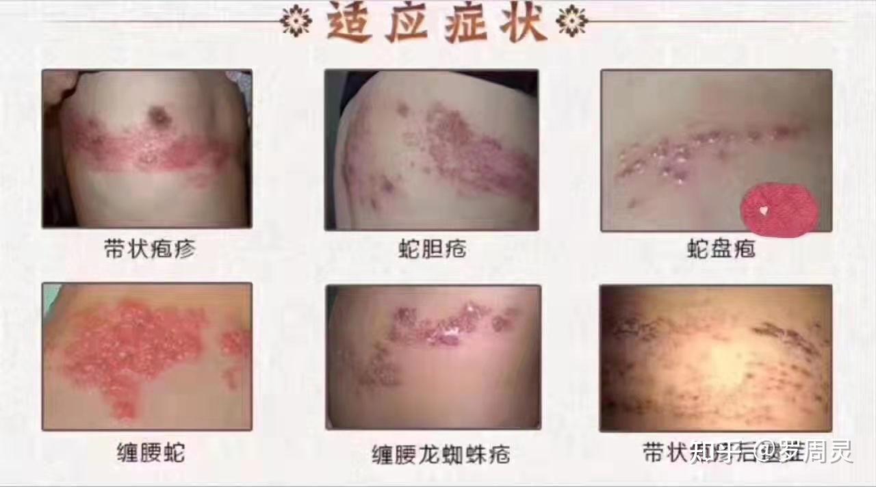 【帶狀皰疹】蛇盤瘡,蛇膽瘡,纏腰蛇,纏腰火龍,地區不同,叫法也不同.