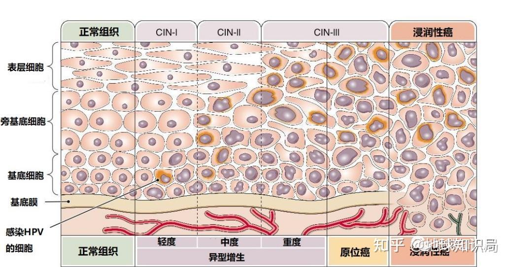 尖銳溼疣俗稱