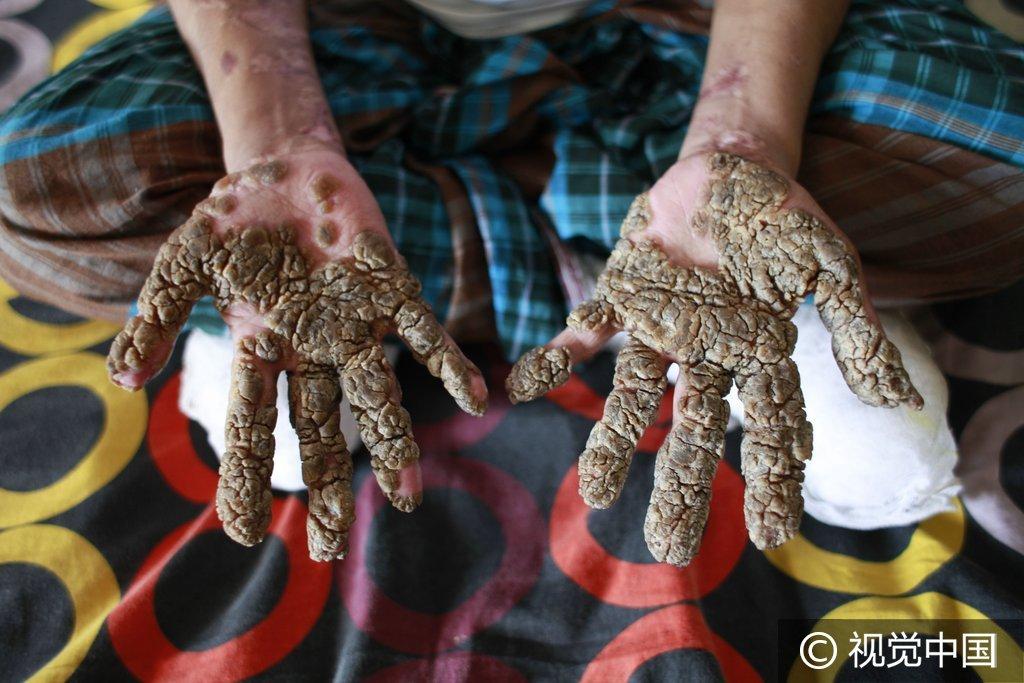 孟加拉国26岁男子患怪病手脚长树根异常可怕