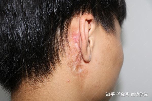 江西16岁小周耳朵手术疤痕疙瘩治疗案例