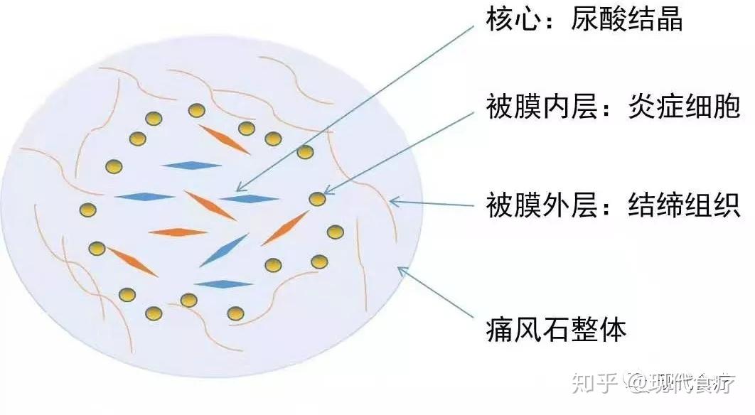 尿酸鹽結晶本身,而不是想辦法和對身體有抗氧化保護功能,溶解狀態下的