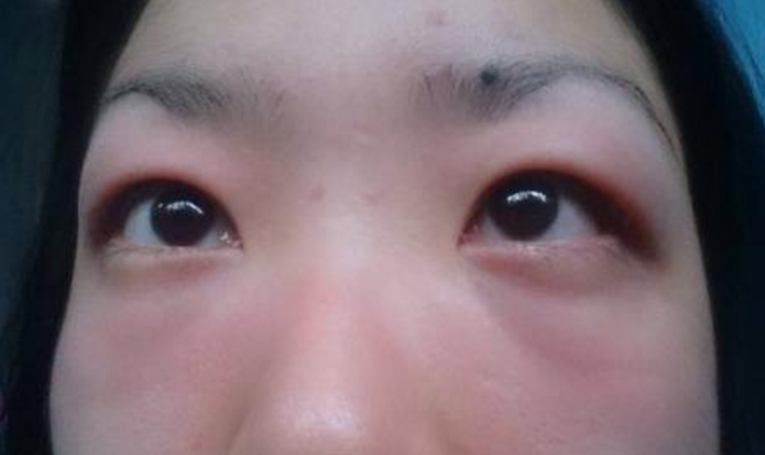 起症原因:眼睛肿胀,眼睑肿胀的原因可能包括:受伤过敏症蚊虫叮咬眼眶