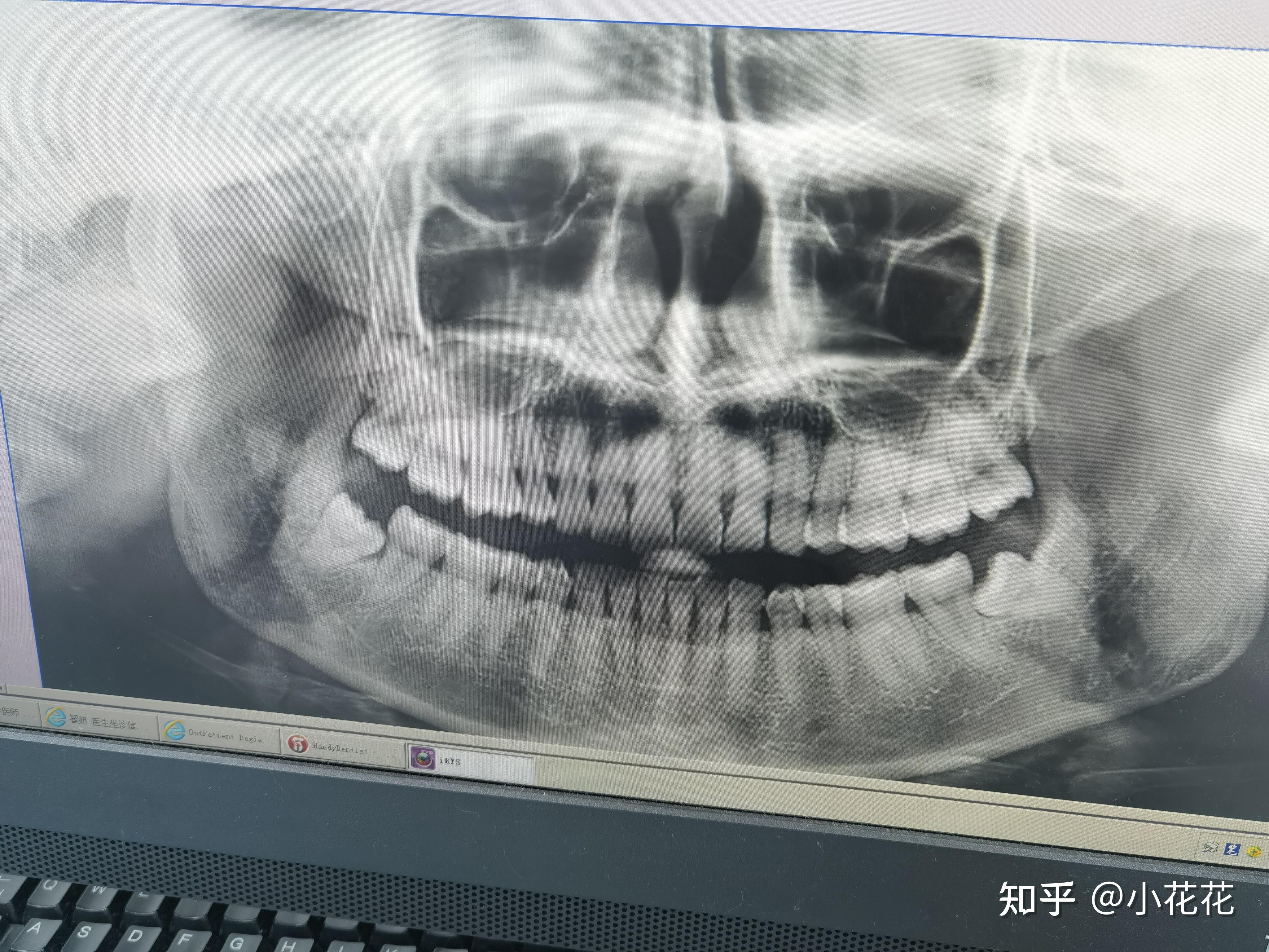 我的急性冠周炎(智齿发炎)以及拔四颗智齿的经历