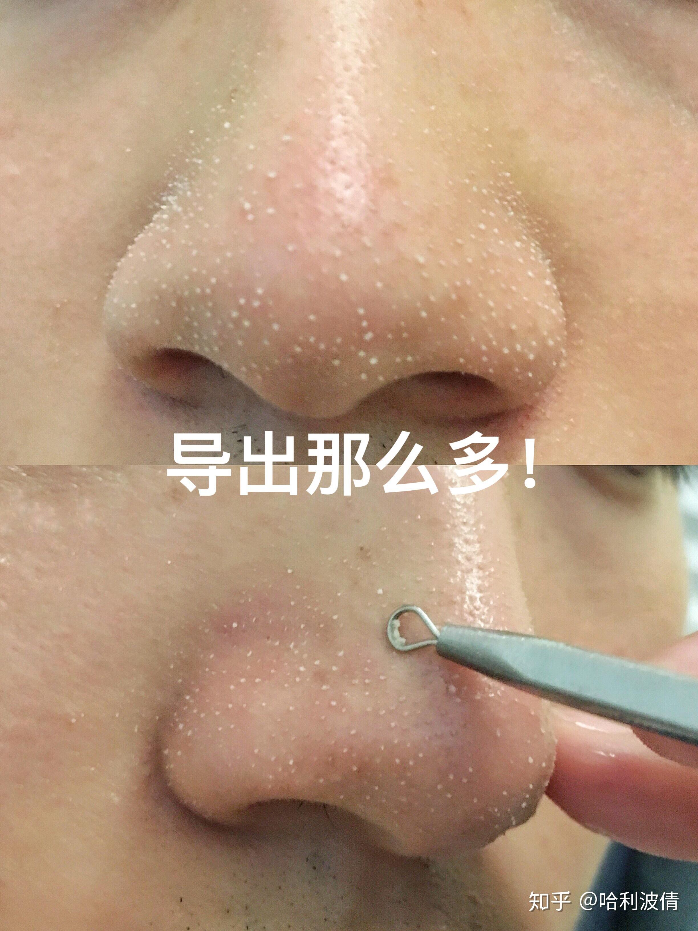 妮玛这个脂质微丝到底是个啥玩意