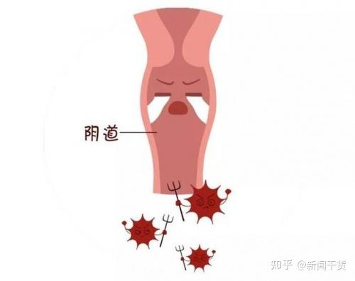 陰道炎在女性當中可以說是最為常見的疾病了,可分為細菌性陰道炎,黴菌