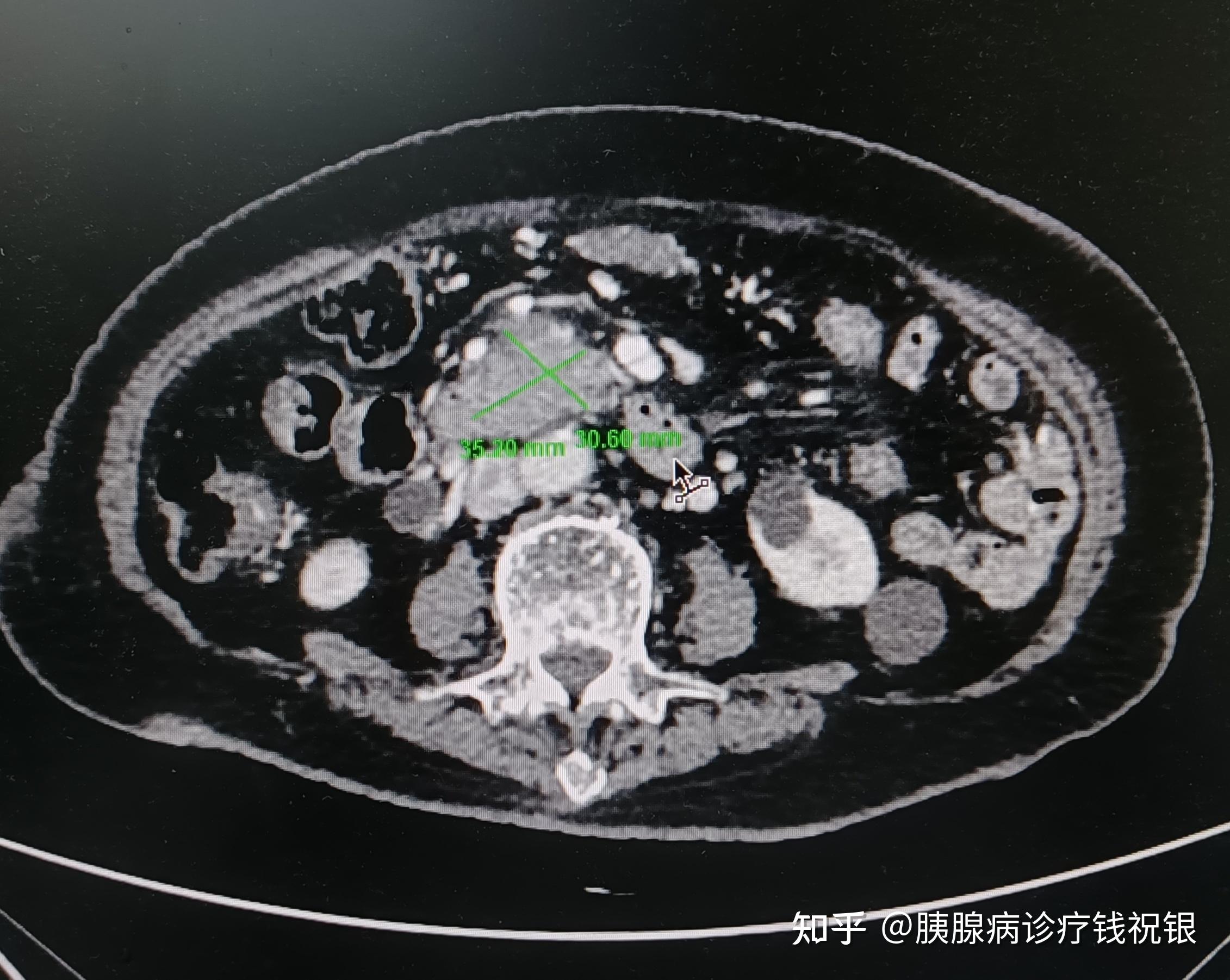 抗癌故事 根治性冷热复合消融显神威