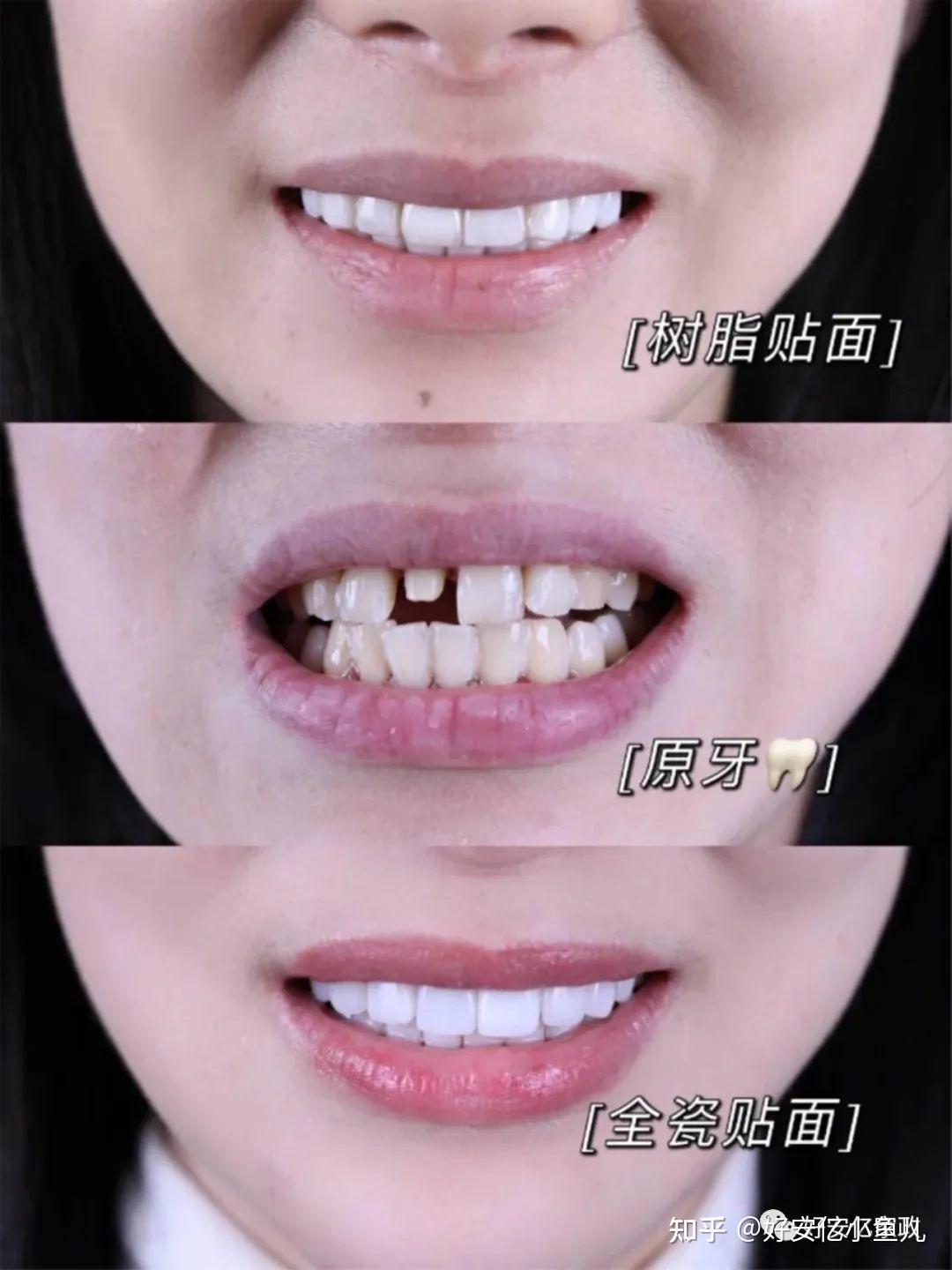 贴面修复案例 – 牙精英口腔