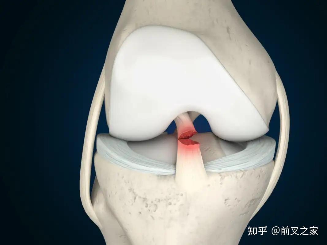 原生的前叉韧带都能断,重建的能顶住? - 知乎