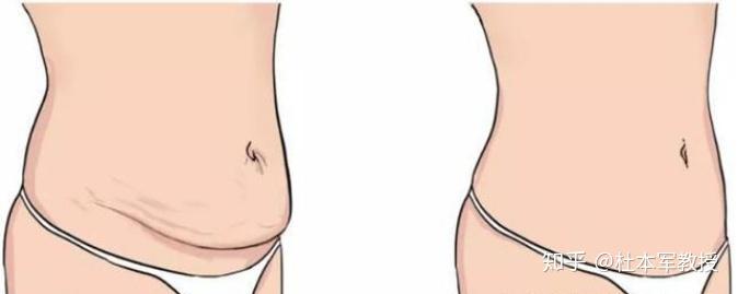 腹部有大量脂肪堆积或膨松的肚皮所困扰而又不想节食或运动的看过来