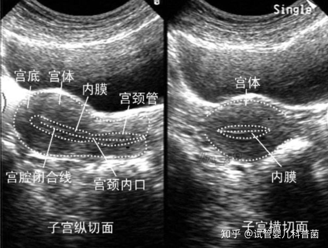 试管婴儿移植,子宫内膜薄怎么办