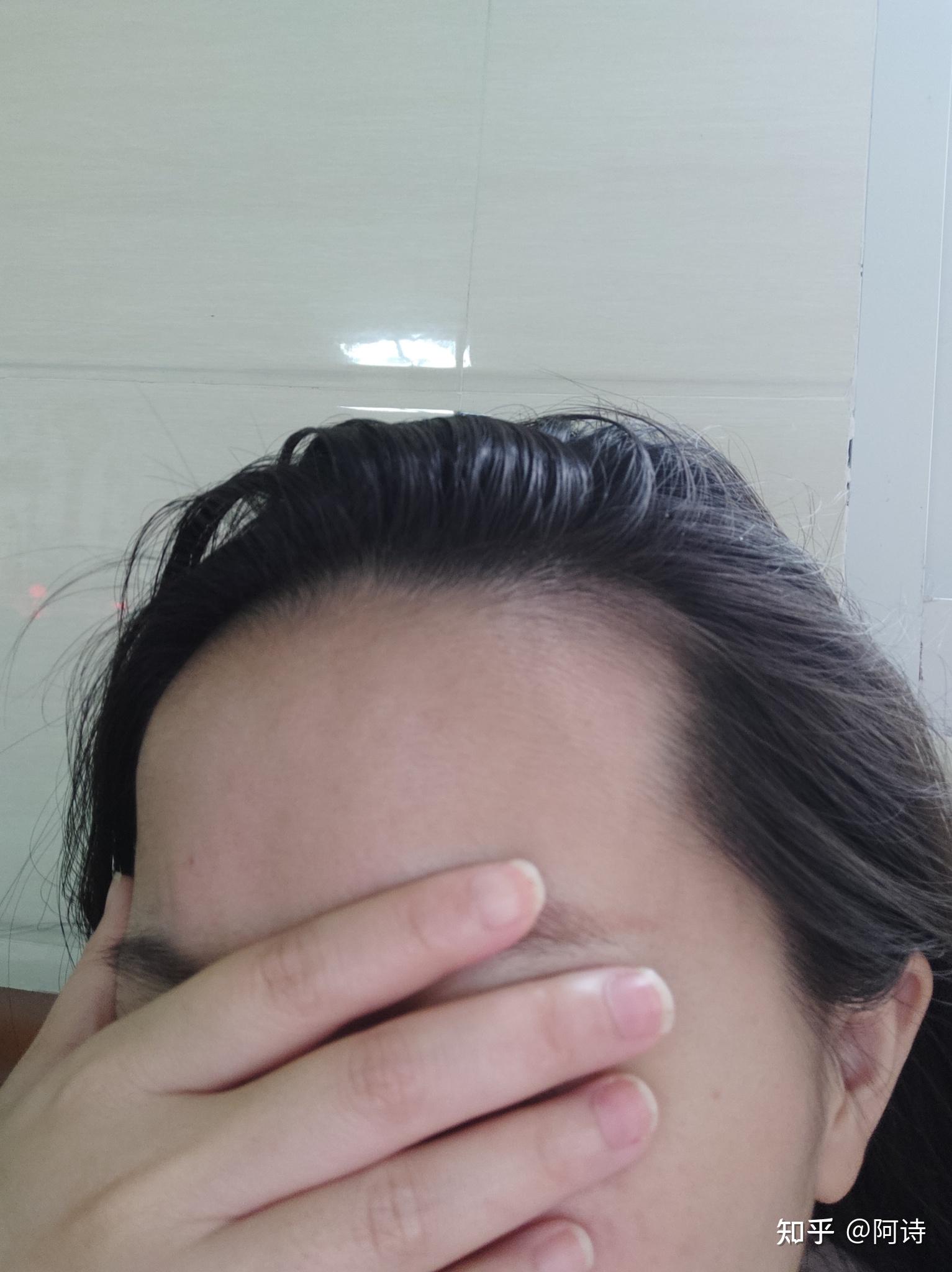 额头凸和发际线高这两点一般都会同时存在吗? - 知乎