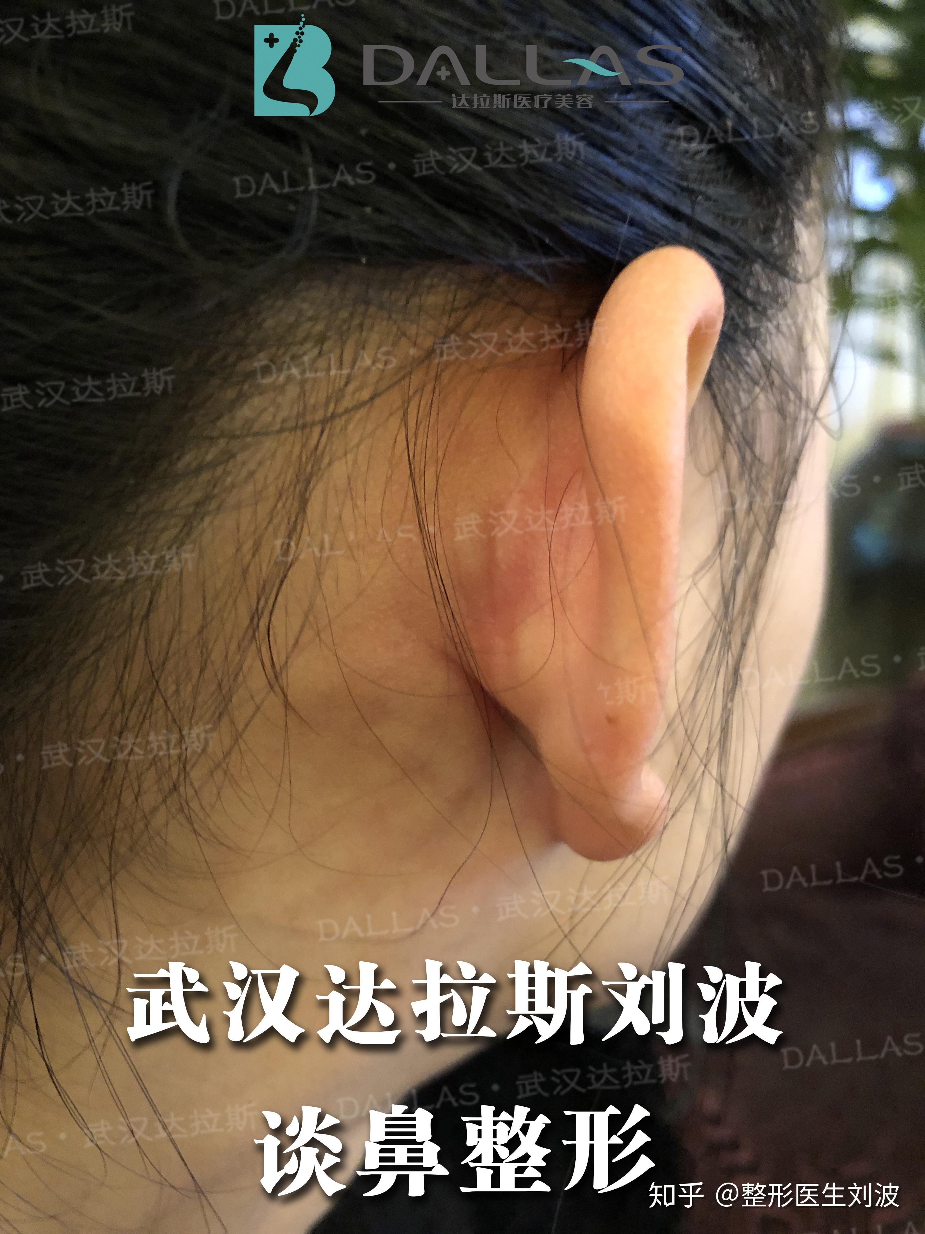 为什么耳软骨有的在前面取走的在后面取前面留疤多丑啊