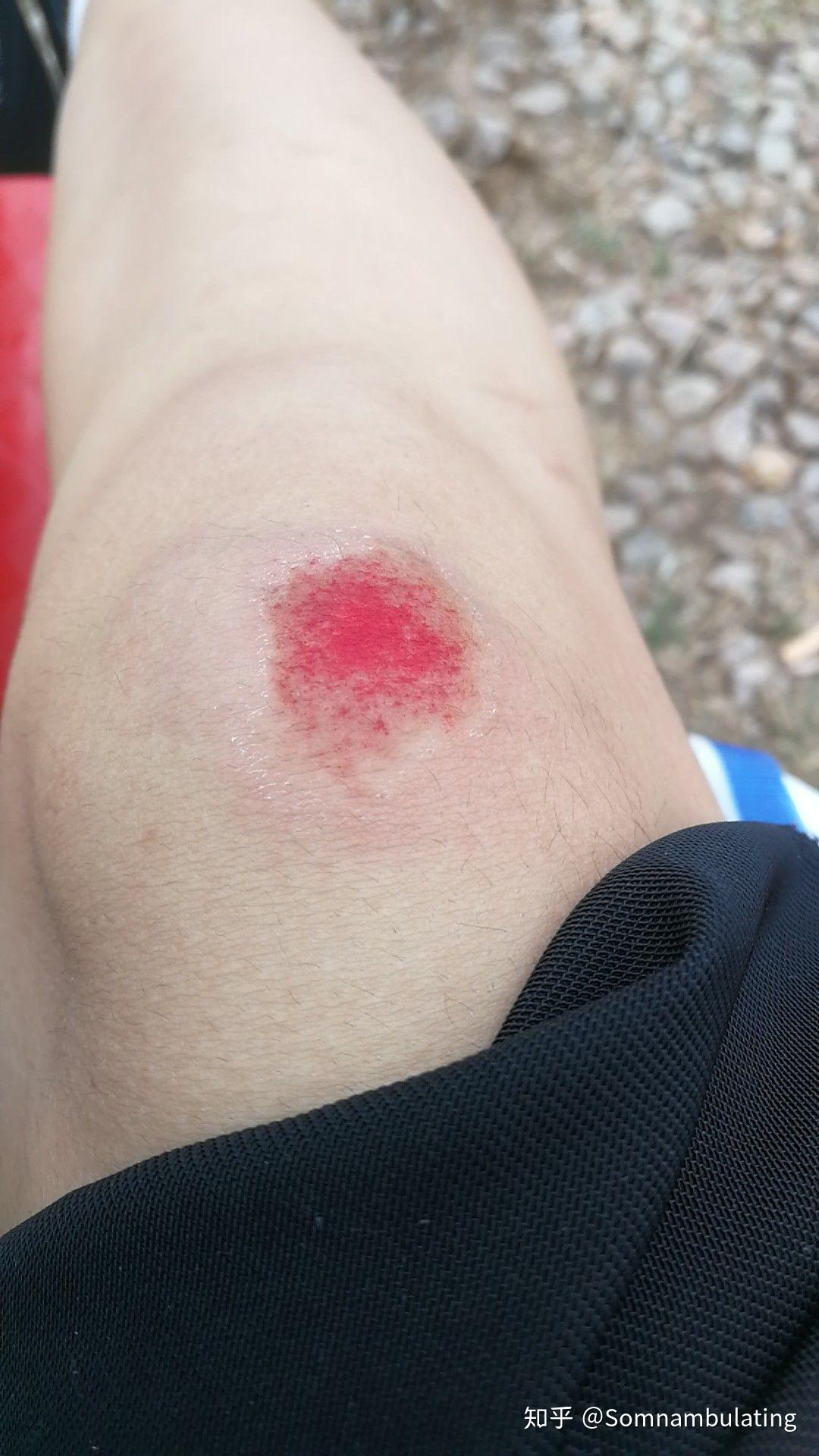 这是刚擦伤时拍的.怎么擦伤的?