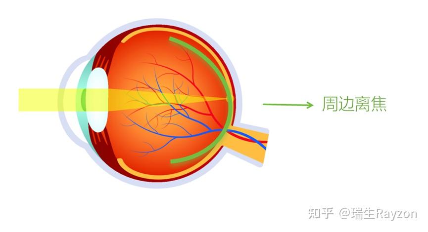 离焦镜-近视防控新利器与视觉质量的平衡 - 知乎