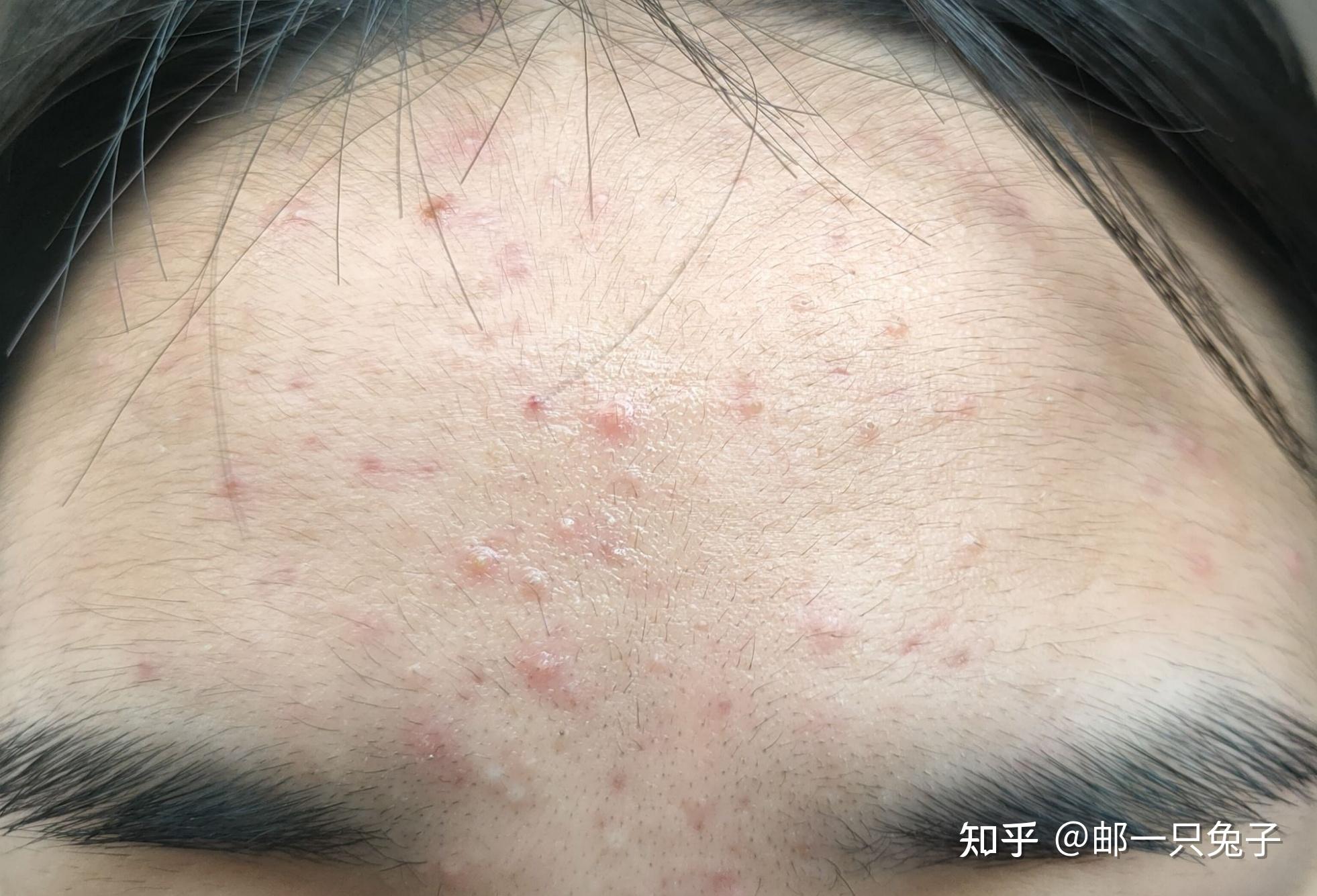 阿达帕林祛闭口记录帖 - 知乎