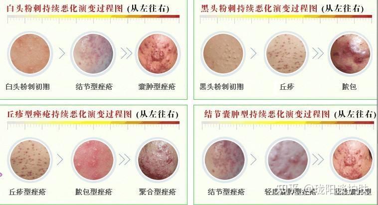 黑头是怎么形成的?为什么总是挤了又长?怎么消除? - 知乎