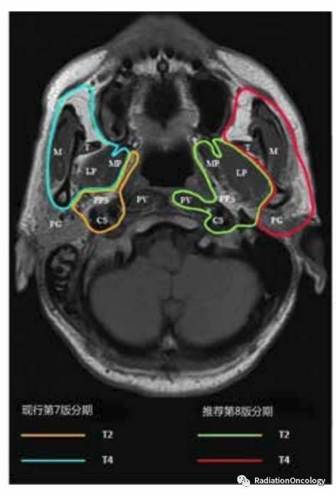 鼻咽癌4种分期的咀嚼肌间隙