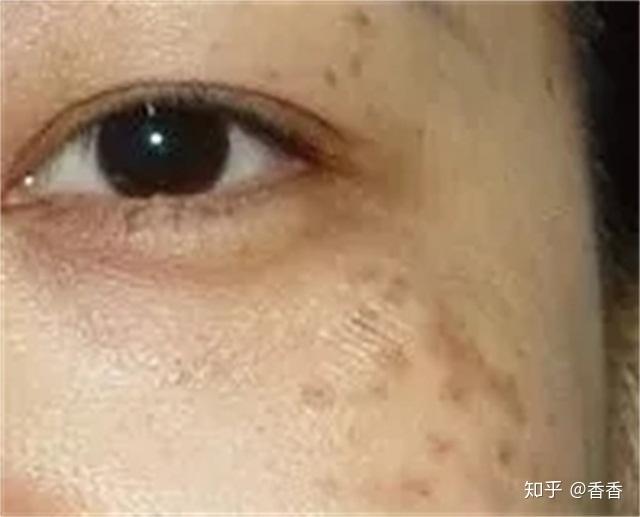 最常出现的色斑种类你知道几种看图识斑