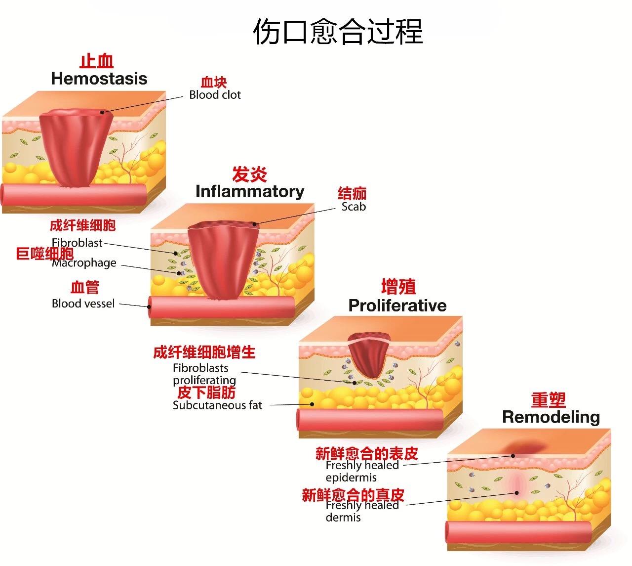 伤口愈合过程是怎样的?