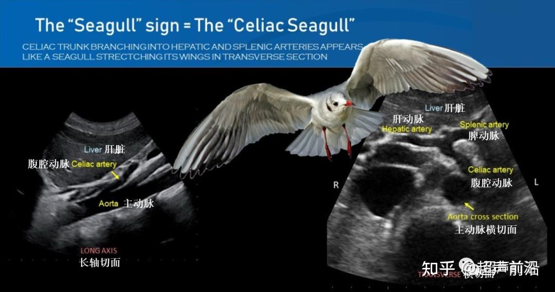 — "海鸥"征胆囊壁增厚呈"鱼嘴"状外观