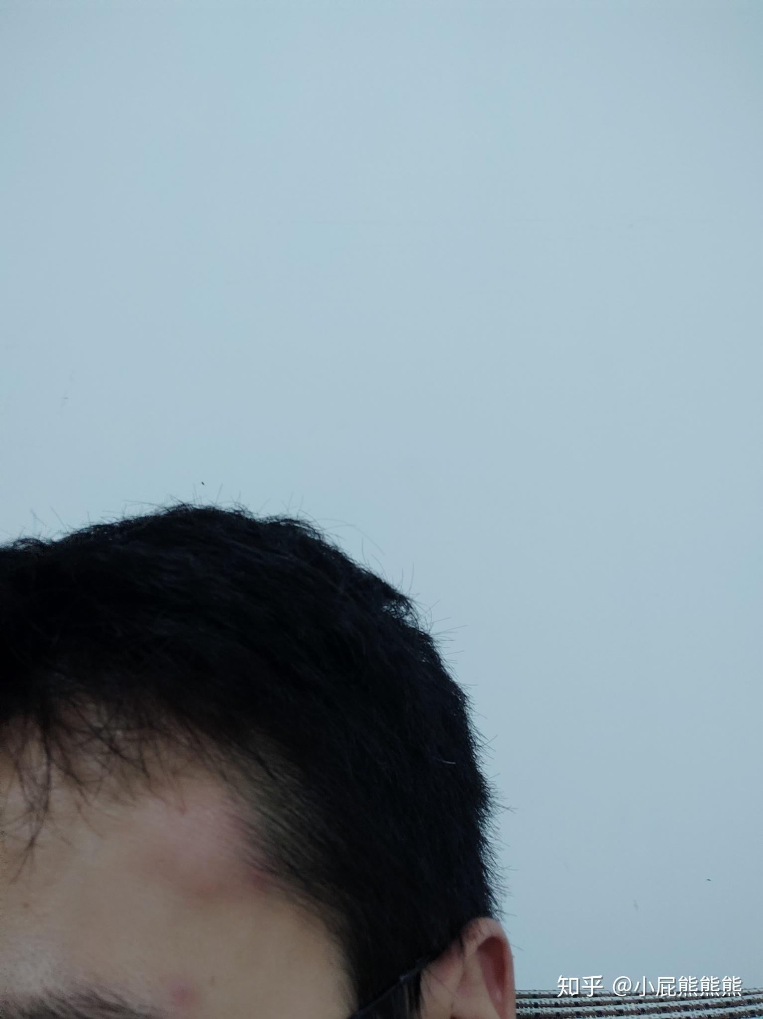 头上鼓了一个包,看医生无果,求大神指点? - 知乎