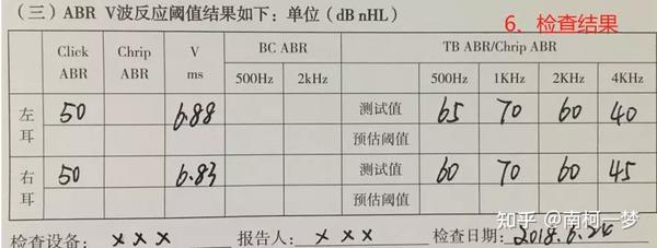 如何看懂电生理报告?(ABR篇) - 知乎