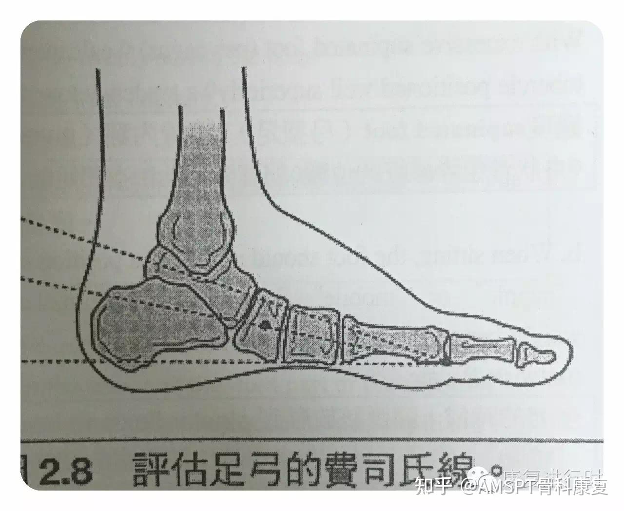 二度扁平足 下1/3位置.三度扁平足舟狀骨落到地面上.