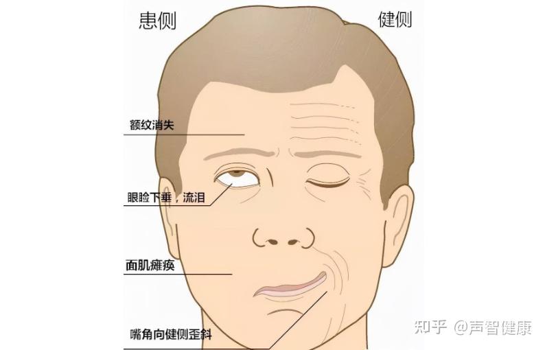 3天急性發病女子溼著頭髮騎車吹成面癱嘴歪眼斜閉不上眼