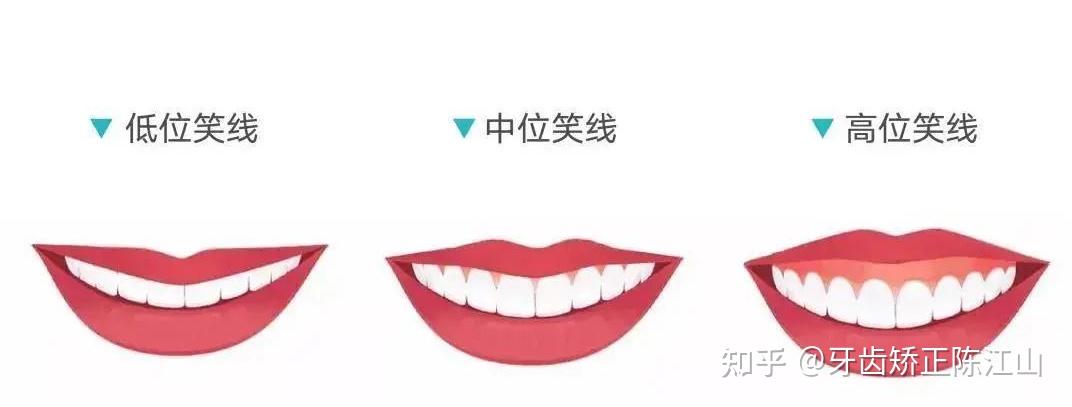 牙齿矫正丨笑线是什么？如何获得？ - 知乎