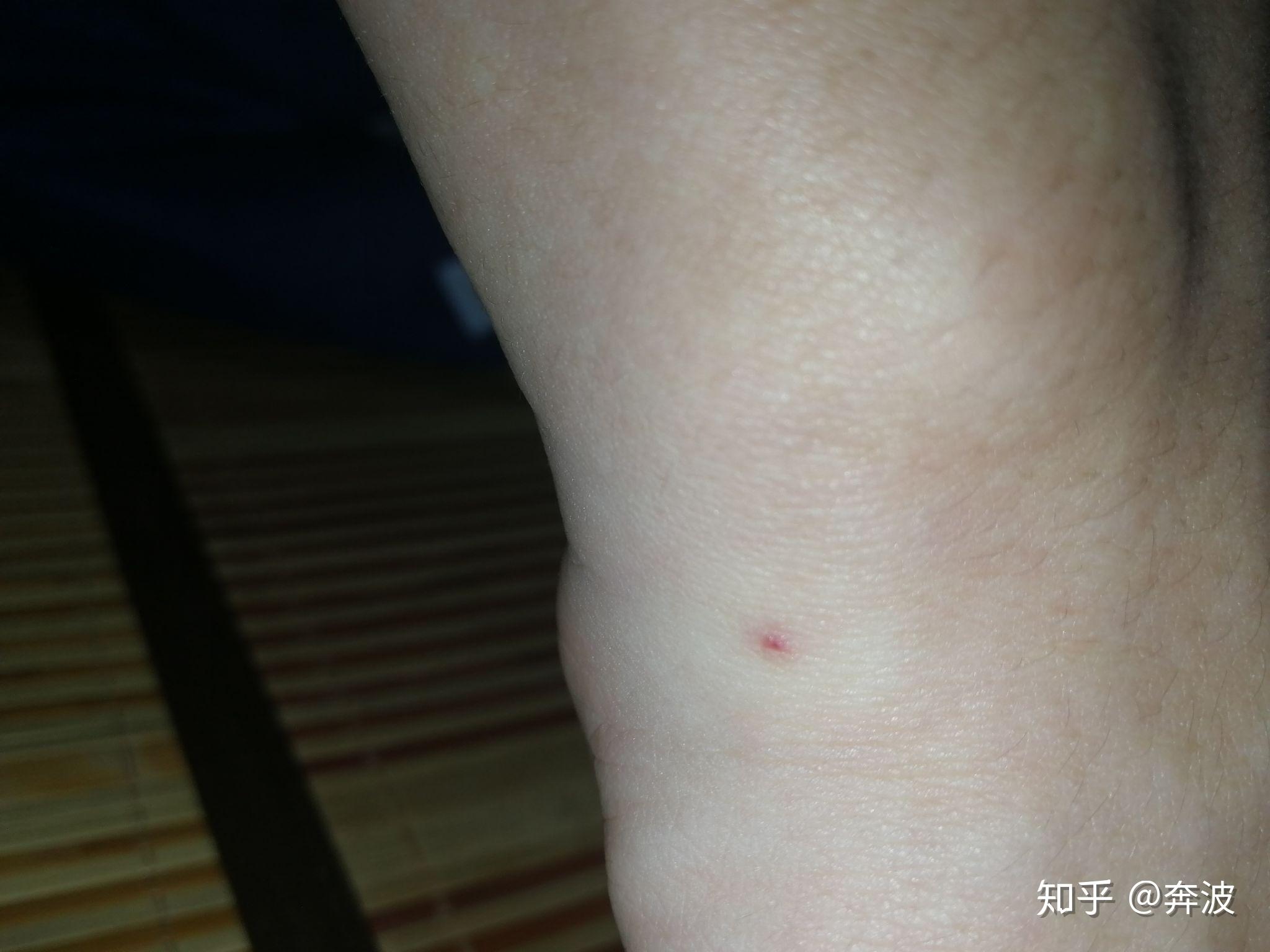 手上长红点红痣血管痣