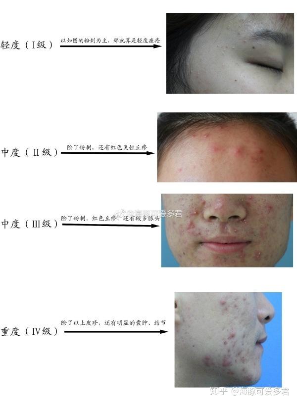 刷酸之后脸上有很多粉刺 v2-b31b05d7b586e31ec47300bdab5b30cd_r.jpg