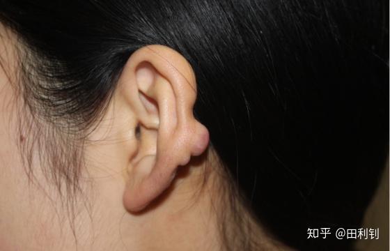 病例分析河南齐女士耳朵瘢痕疙瘩