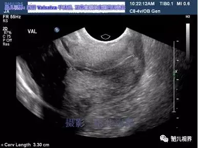 经阴道超声检测宫颈长度的技术