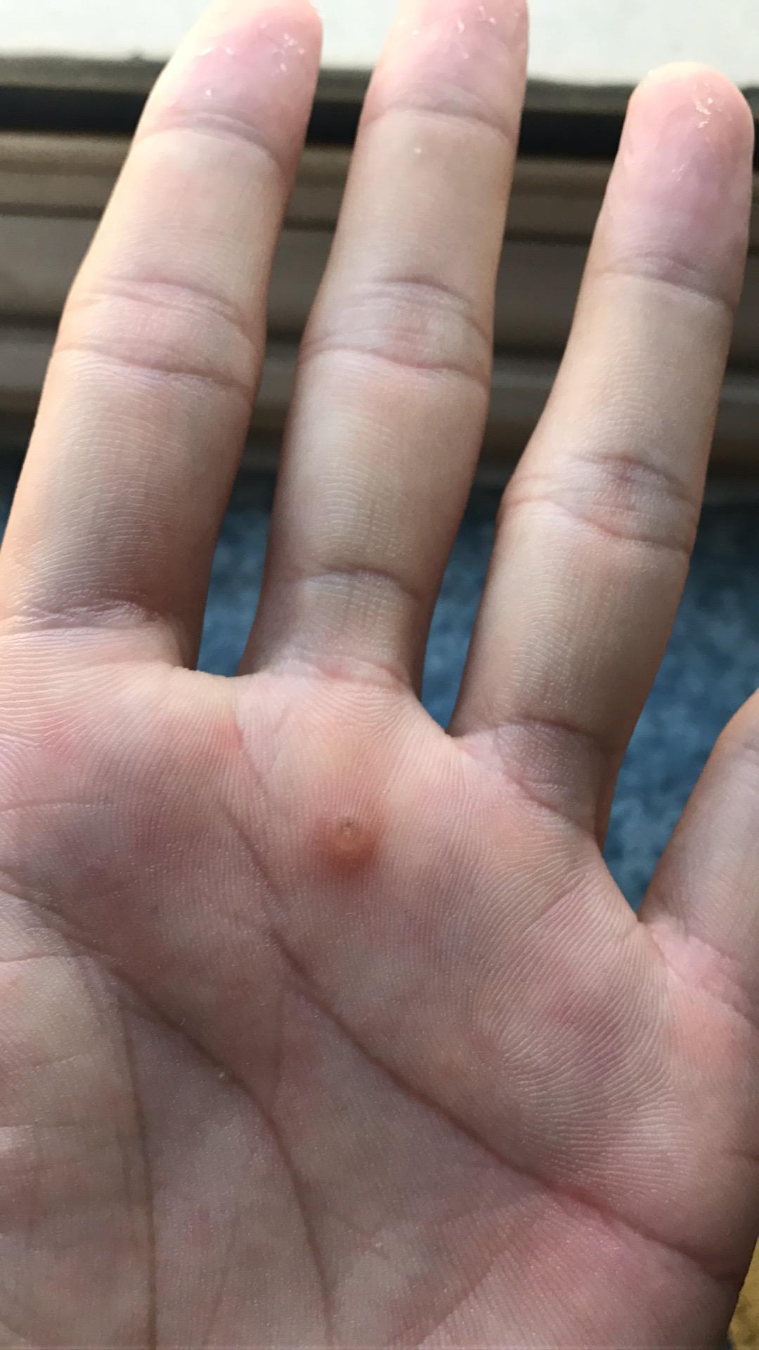 手掌上长了一个小疙瘩? - 知乎