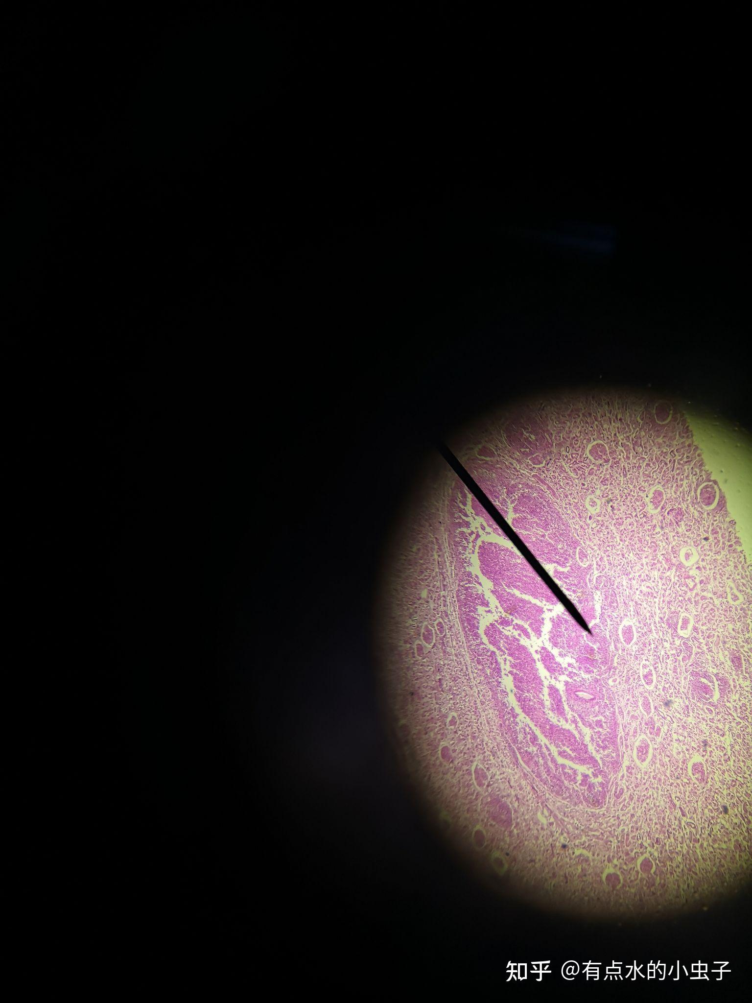 肾脓肿流行性脑脊髓膜炎朗汉斯巨细胞结核性肉芽肿纤维瘤(背景)纤维